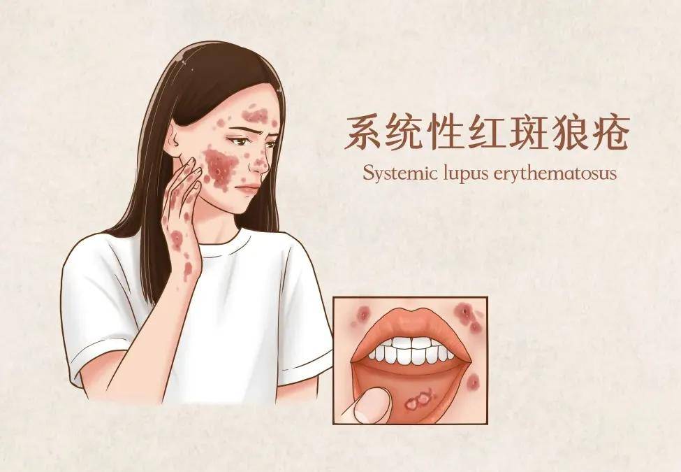 有研究表明，系统性红斑狼疮主要发病机制与t、b淋巴细胞异常活化有关。
