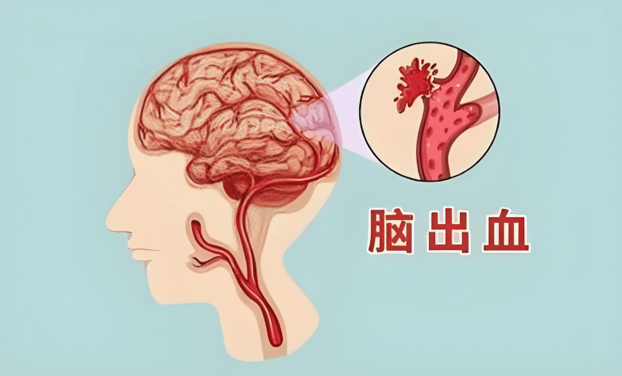 岁运并临遇死亡的八字, 岁运并临的脑溢血患者