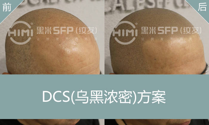 纹发后有发际线吗？改变因脱发造成发际线后移的形象