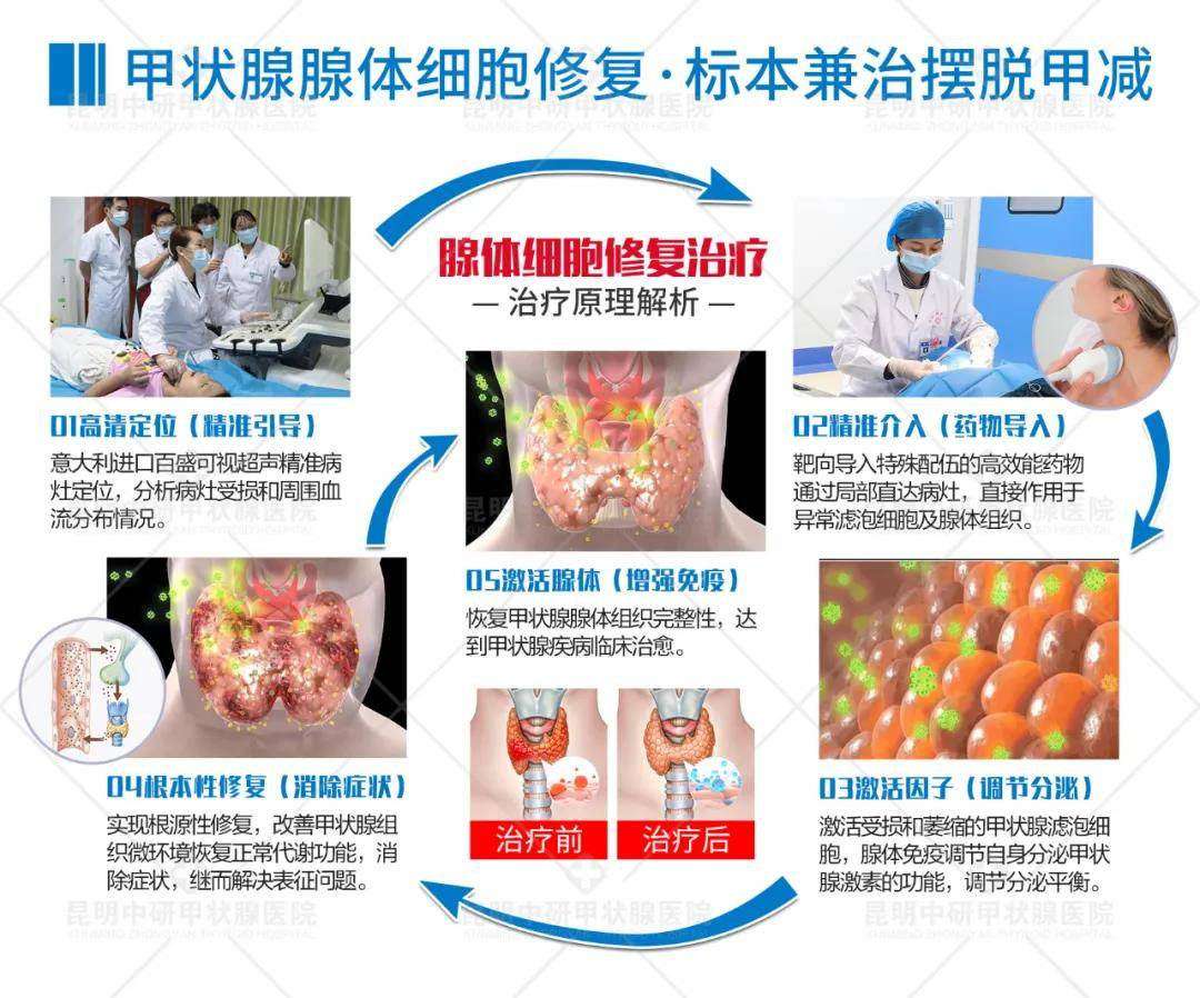 甲减患者必看！甲减的治疗，除了吃药你还有这种方法可以选择！(图4)