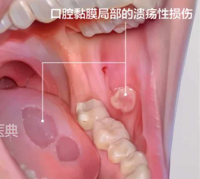 口腔黏膜疾病有哪些？(图2)