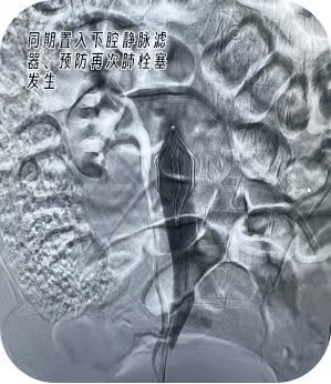 杨凌示范区医院成功开展两例肺栓塞急诊介入手术(图2)