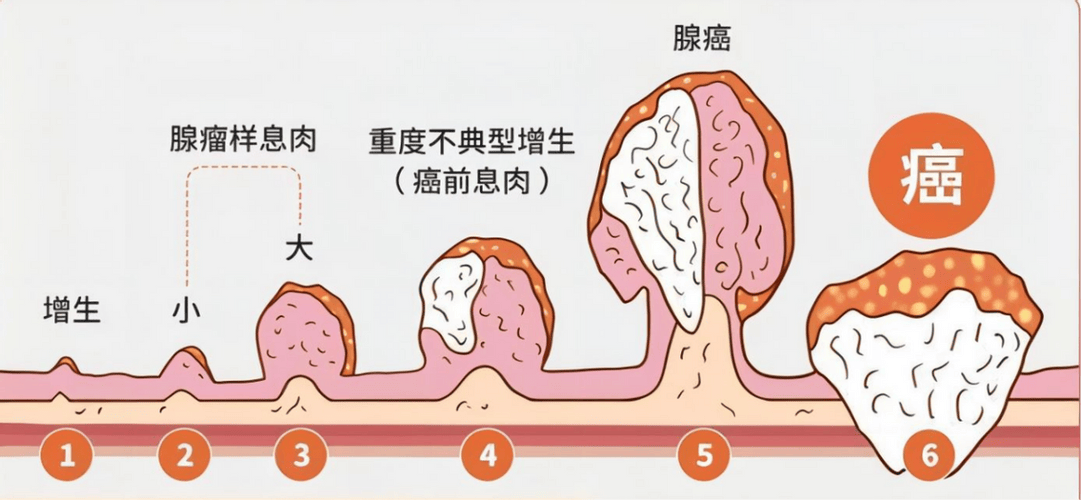 胆汁反流性胃炎饮食如何调理？