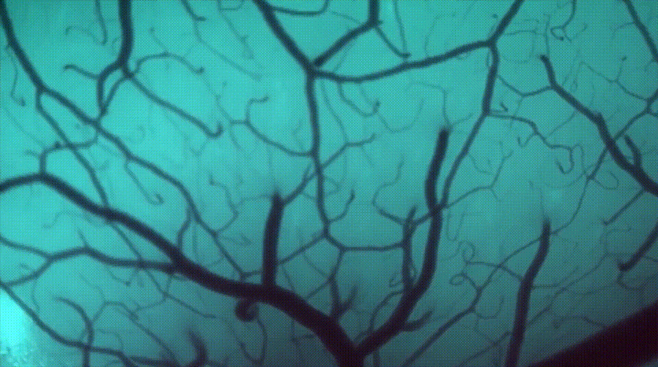 马斯克脑机接口重大突破！万人排队「开颅插针」