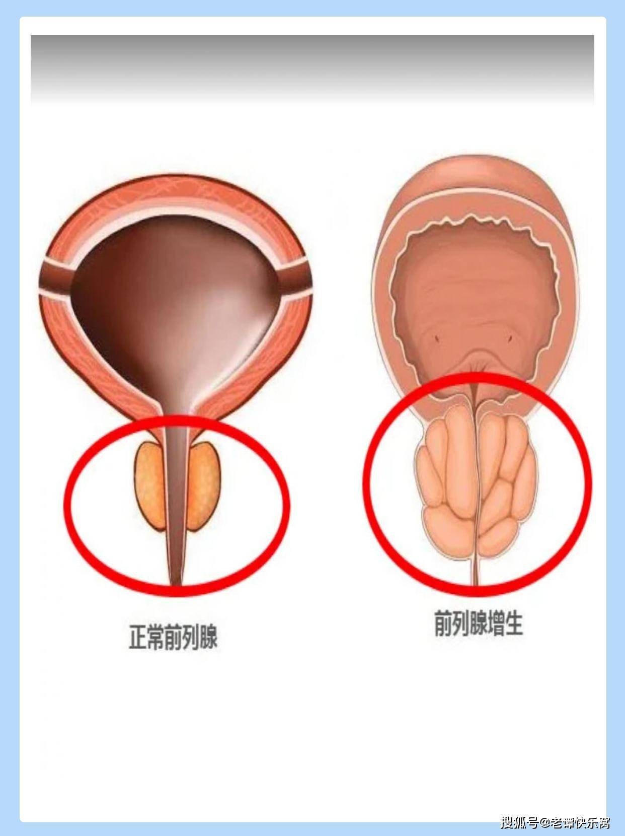 前列腺肿大导致老是有便意