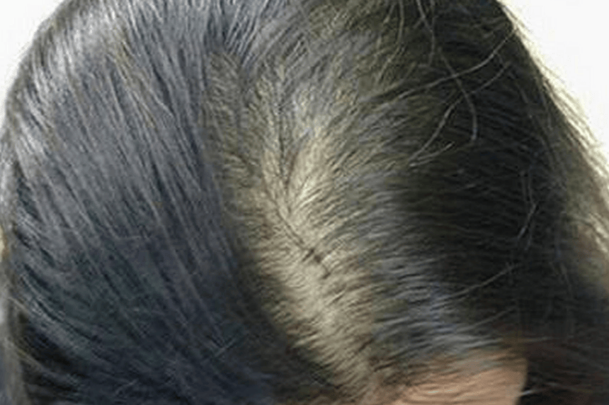 生完孩子严重脱发怎么办?如何改善?