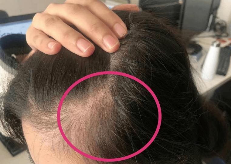 生完孩子严重脱发怎么办?如何改善?