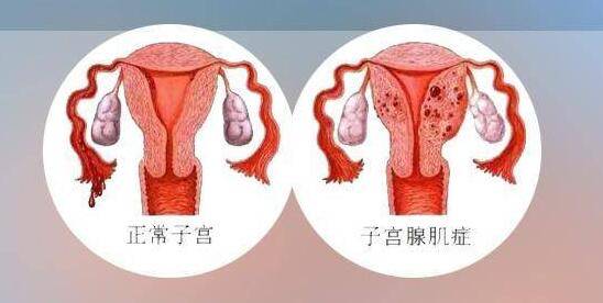 子宫性不孕：子宫腺肌症为什么会影响怀孕--郑州天伦医院