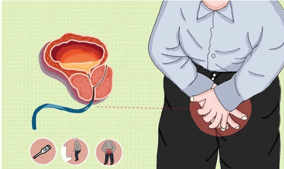 男科专家讲解：了解前列腺疾病，守护男性健康(图2)