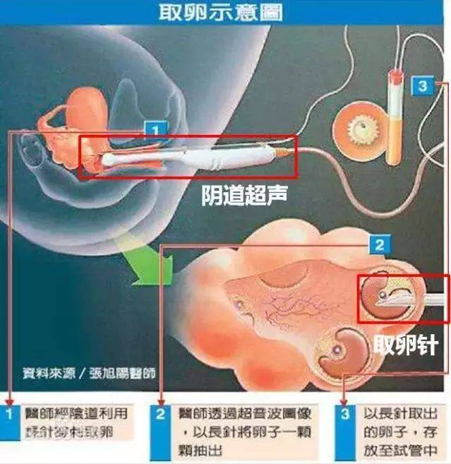 广州生殖医学中心的供卵技术探索与实践 广州生殖医学中心的供卵技术探索与实践