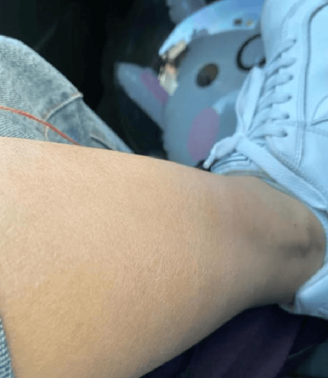 湿疹用什么药好得最快最有效