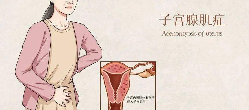 患有子宫腺肌症，该如何怀孕呢？