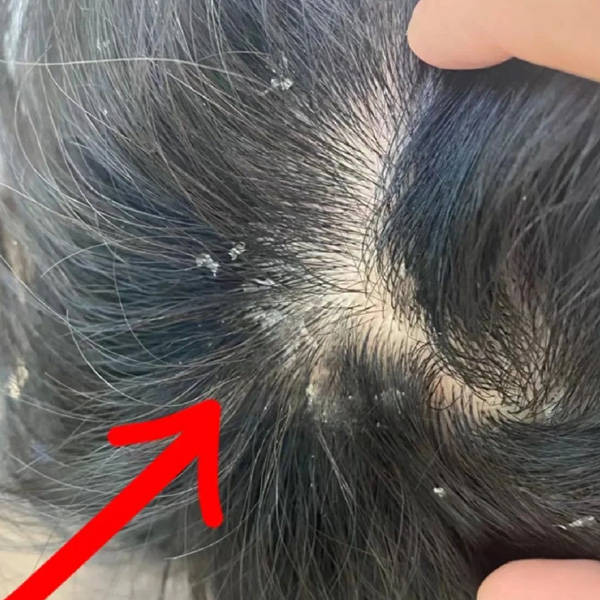 头上头皮屑特别多是什么原因造成的?（头上长红疙瘩什么原因）