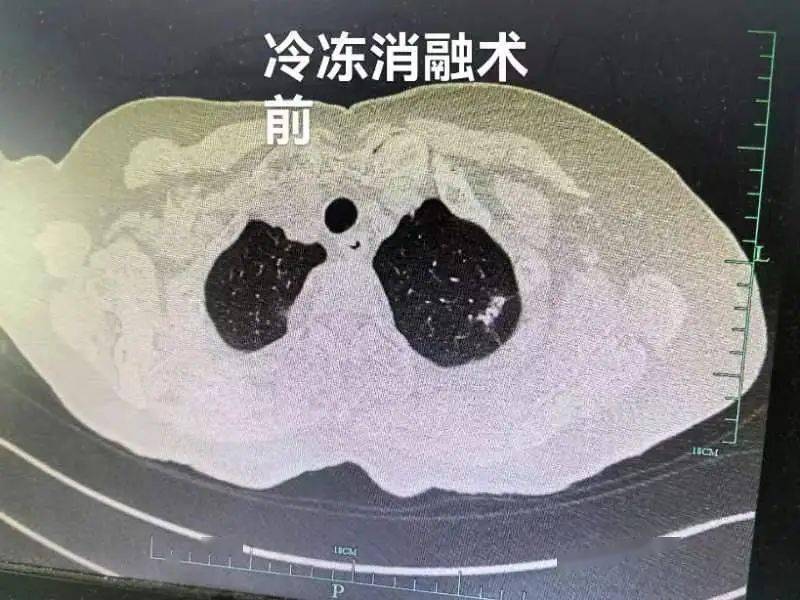 【新闻快递】呼吸一科成功实施冷冻消融术，为高龄肺癌患者带来新希望