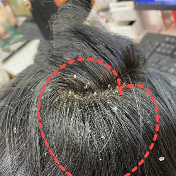 头皮问题产生原因如下： 头皮屑的产生通常与以下原因有关： 皮脂不平衡：头皮上的皮脂分泌不足或过多都可