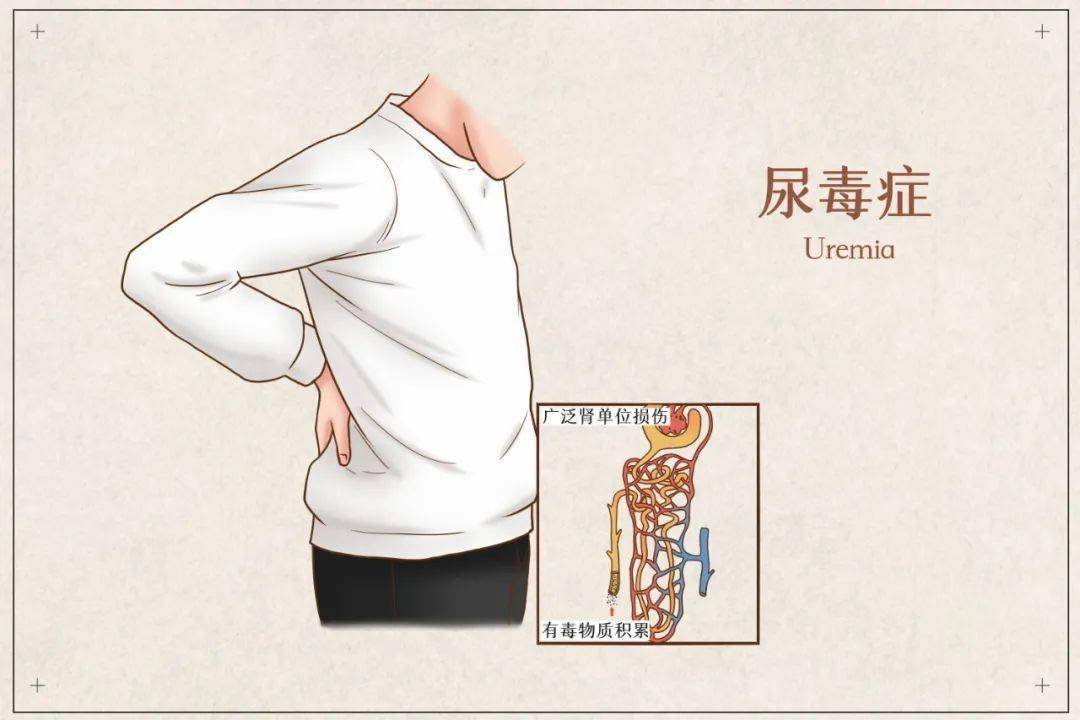 逸仙科普丨尿频尿急别忍！当心忍出尿毒症