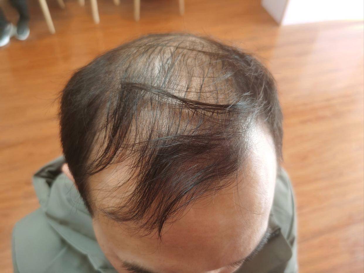 生发液哪个牌子效果最好?生发育发最有效的药!