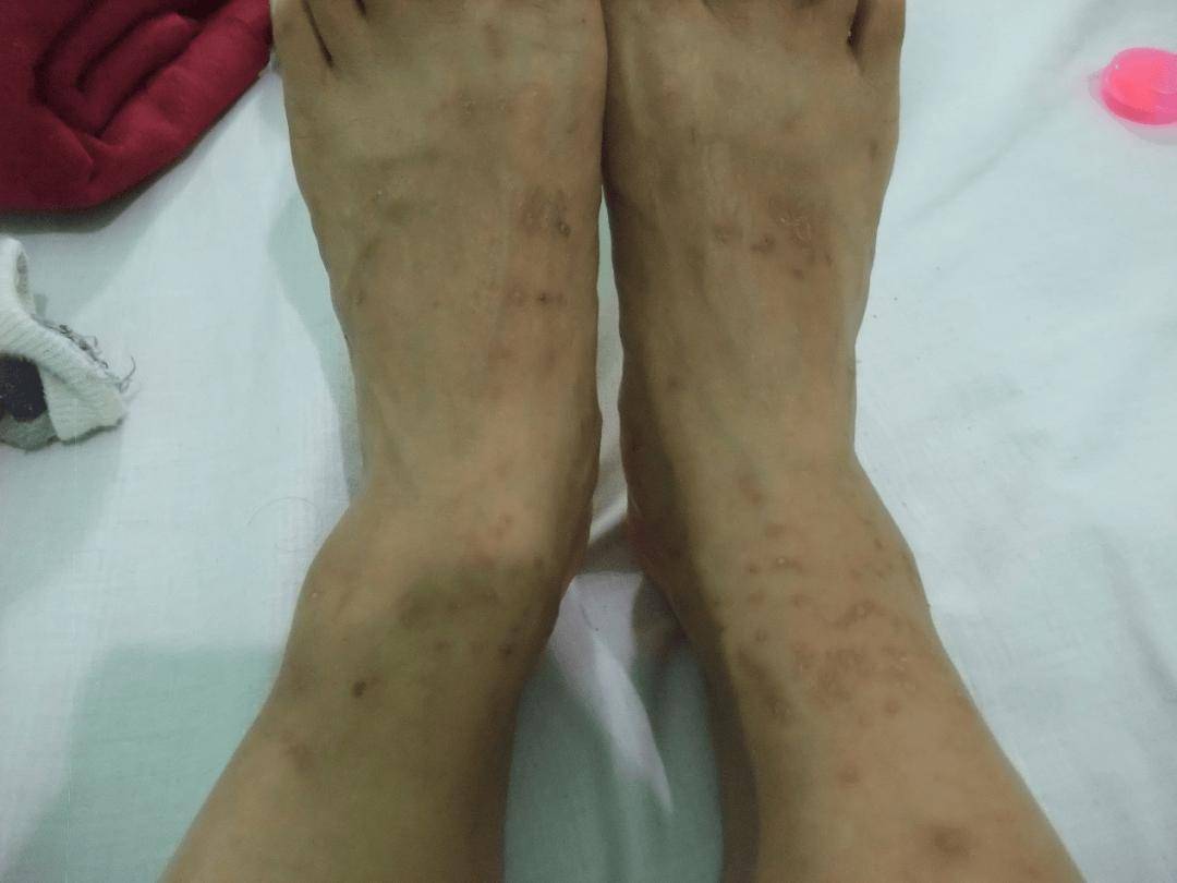 夜里痒到怀疑人生,原来是有虫子在我皮肤里挖洞产卵