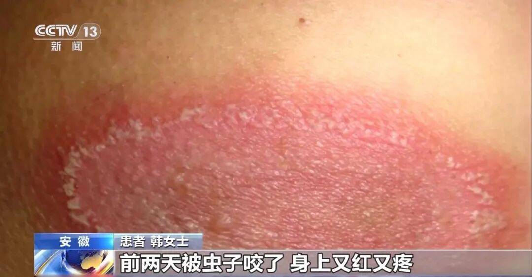 毒液堪比硫酸！近期高发活跃，这种虫子千万别用手拍