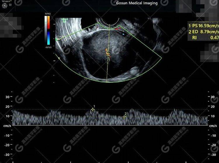 卵巢纤维瘤超声图片图片
