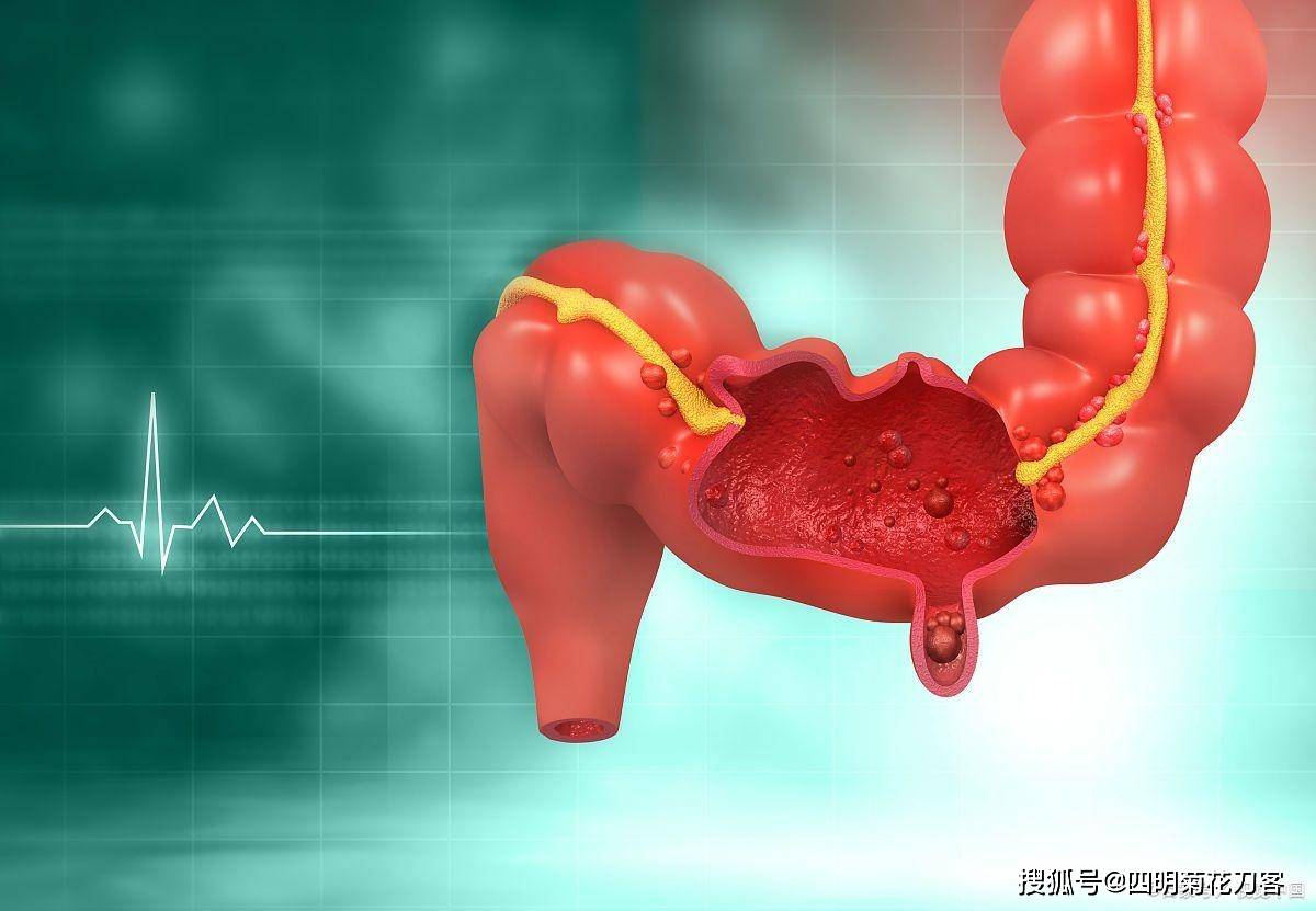 生活越好腸癌越多嗎?聽聽醫生怎麼說_食物_腸道_大便