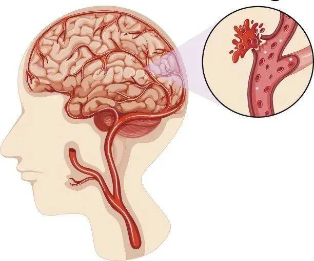 深圳華僑醫院團隊巧手救治,腦出血患者錦旗致謝_先生_血壓_進行