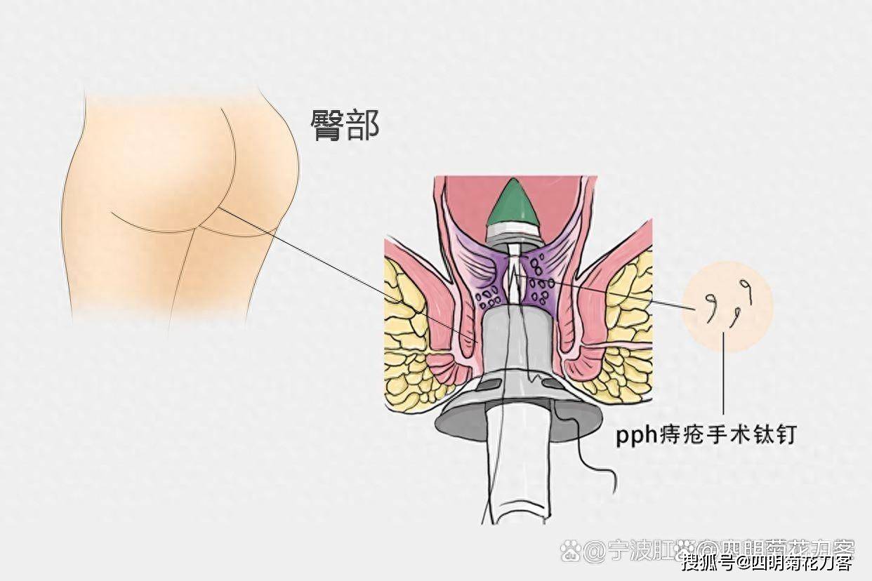 十男九痔,十女十痔,关于痔您是否有很多问号