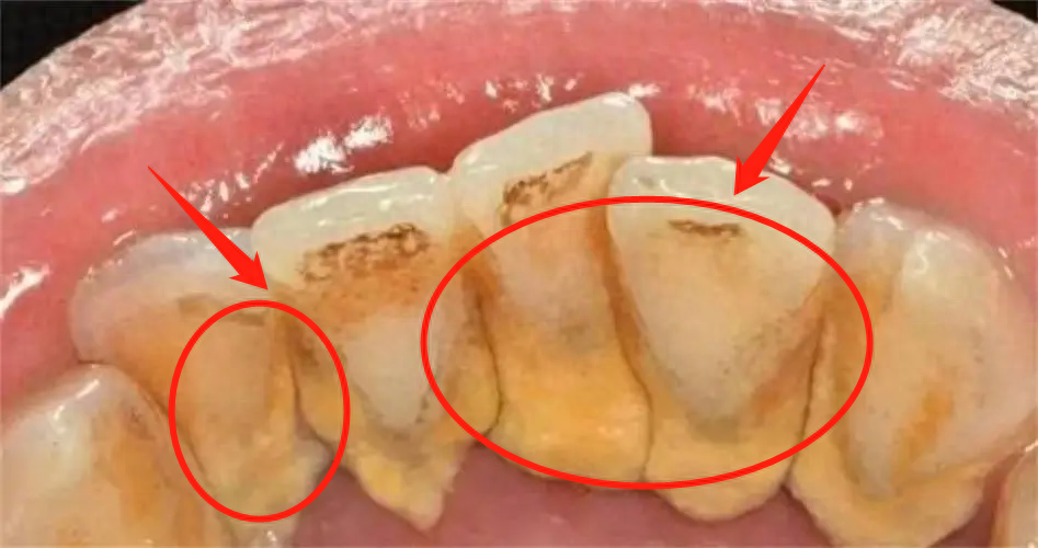 牙齒_方式_牙粉