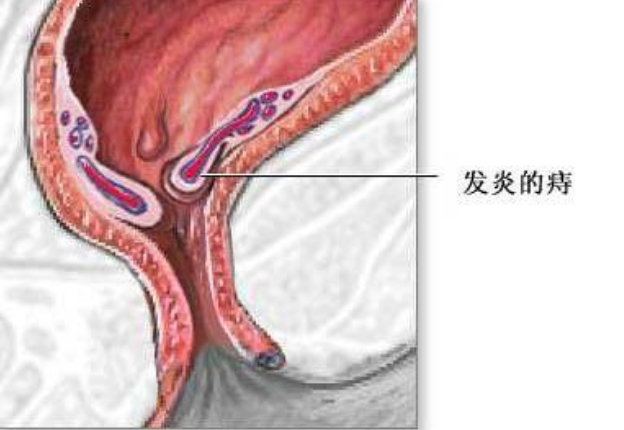 內痔,外痔,混合痔,不僅會便血,還會引發肛周膿腫,肛瘻等症狀,其中最