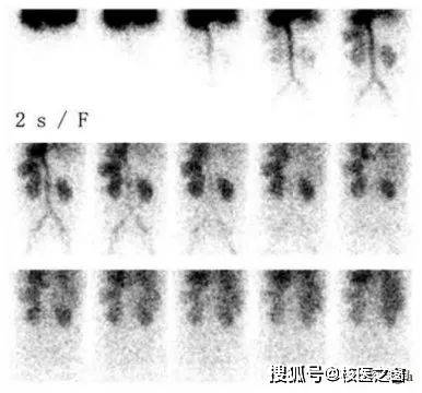 腎動態顯像安全性:具有無創,安全,信息全面,不會加重腎功能損傷(腎