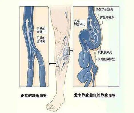 大隐静脉属支图片