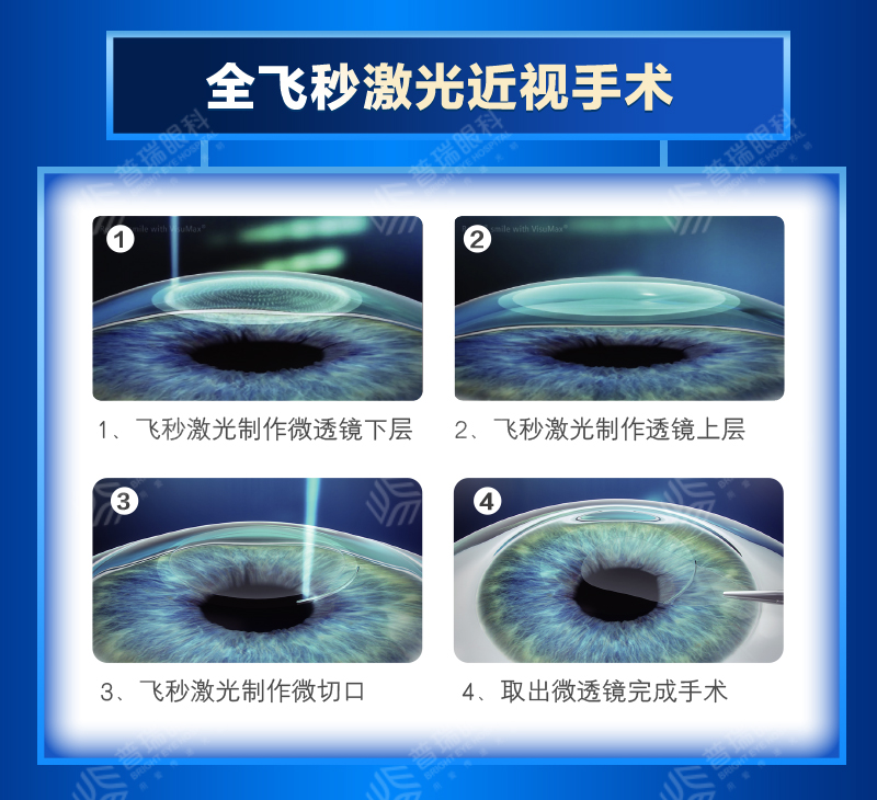 全飛秒手術由於無需製作角膜瓣,保持了角膜表面的完整性和生物力學的