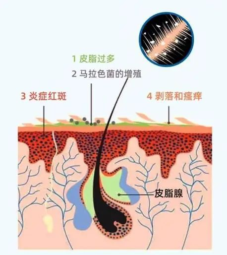 頭皮這幾個重要名詞,你都認識嗎?_馬拉_問題_皮脂腺