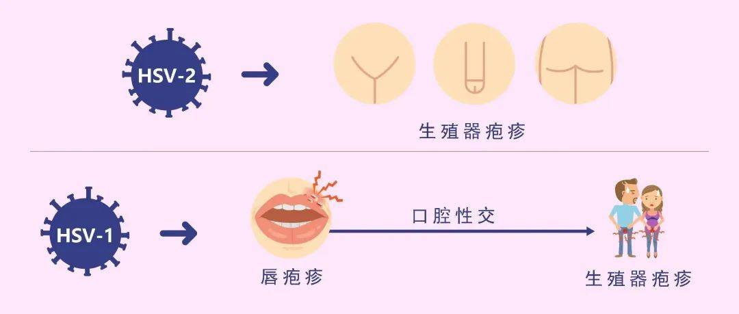 科普 消除生殖器疱疹的"污名"