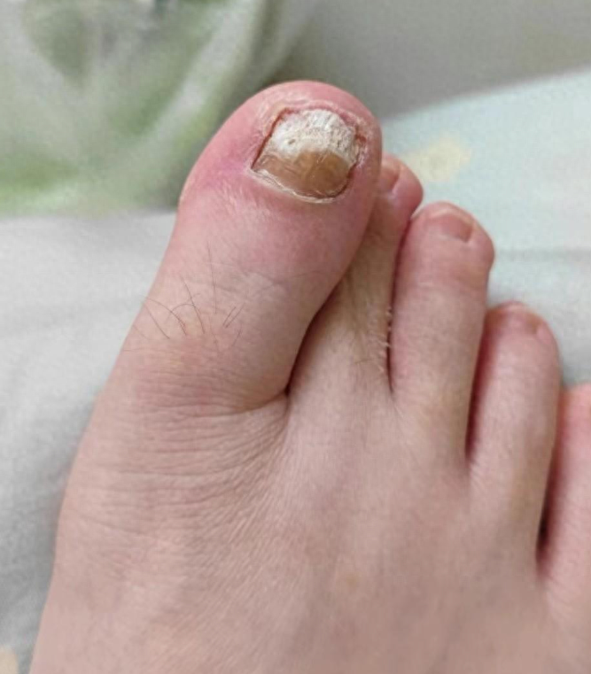 亲测好用,灰甲全无!_效果_灰指甲_症状