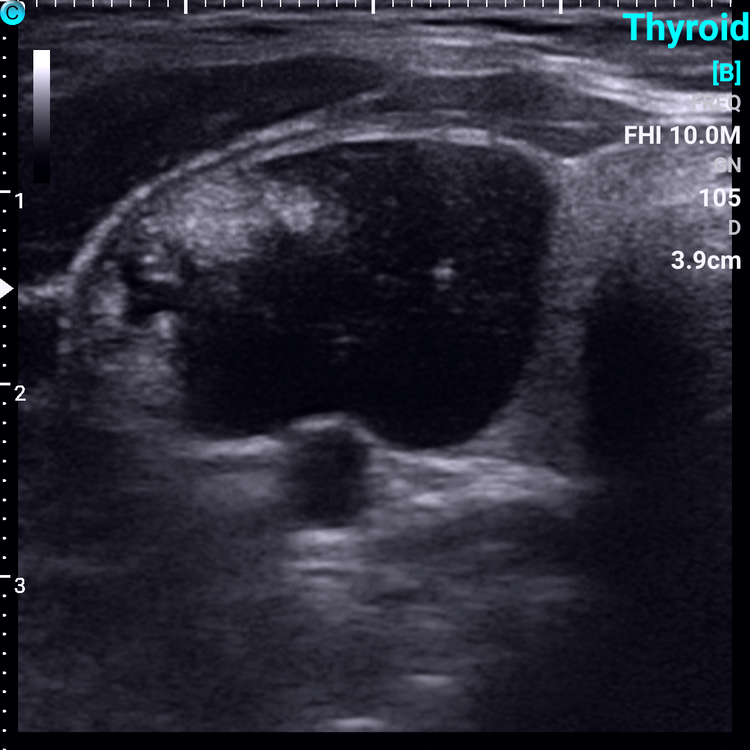 甲状腺结节超声图像图片