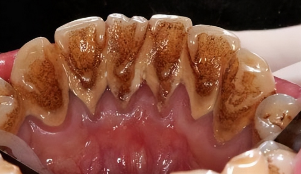 这个牙粉我是花了两个月时间,用空了三盒后彻底解决了牙黄牙石的问题!