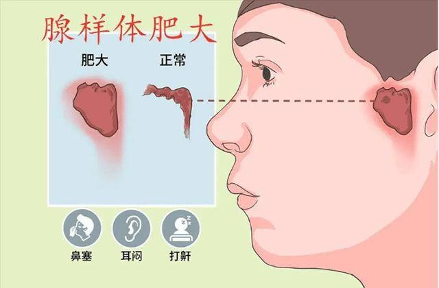 腺樣體手術對腺樣體肥大的兒童治療效果好不好?_症狀