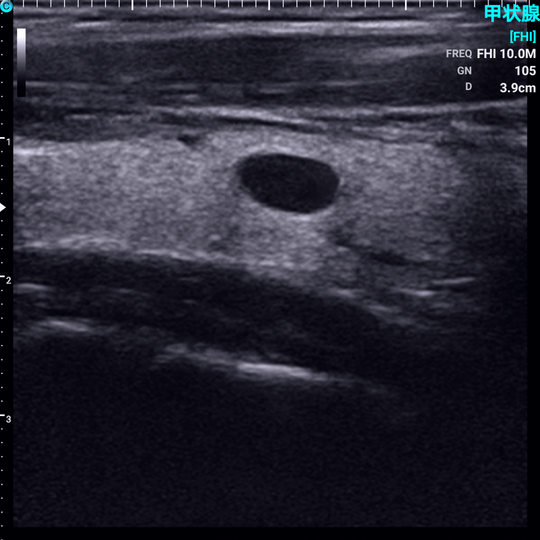 甲状腺结节超声图像图片