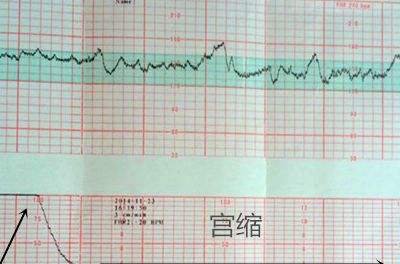 胎心监护不合格怎么办?