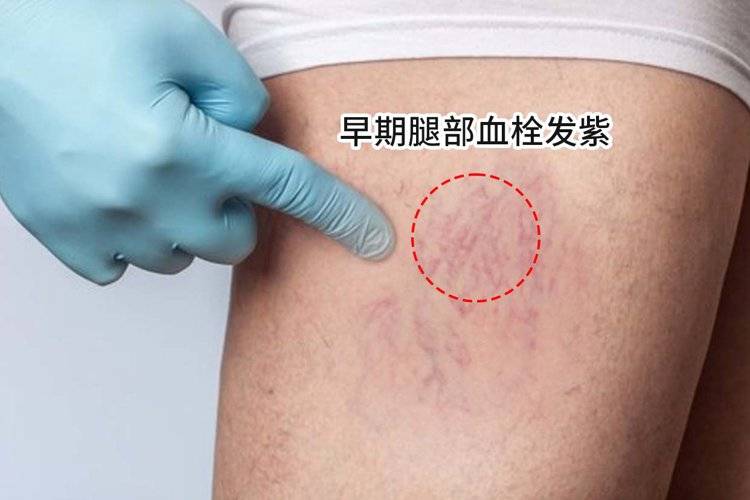 4,颜色发生改变动脉血管发生堵塞,会让体内的血液无法得到很好的循环