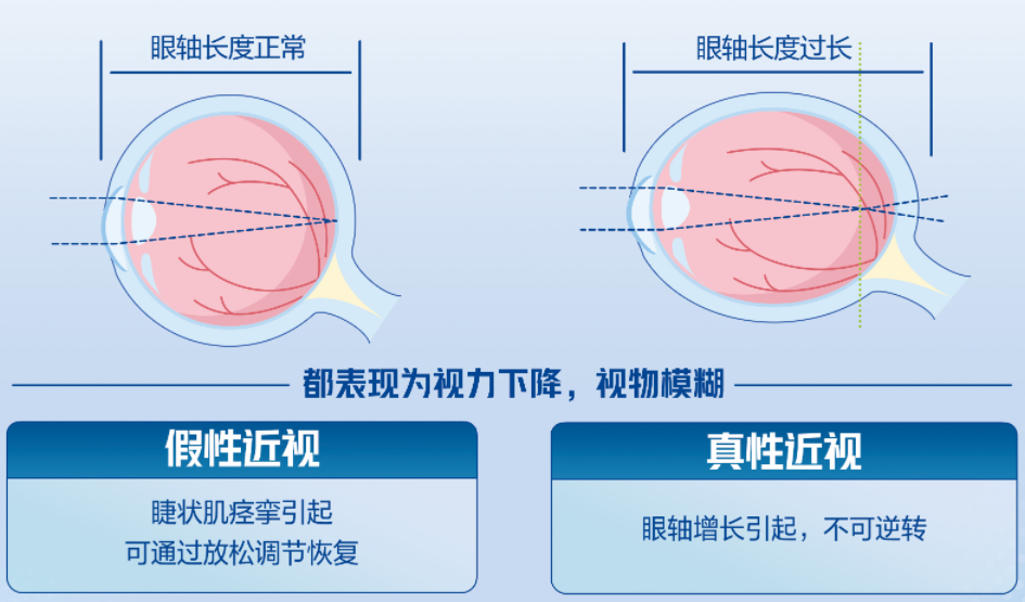 真性近視又叫軸性近視,由於先天或後天因素使眼軸變長,超過了正常