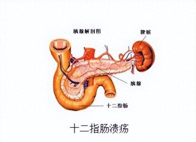 十二指胃溃疡位置图片图片