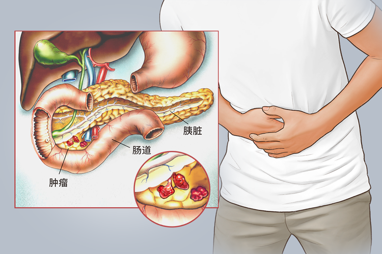 48歲男子每天大便兩三次,確診胰腺癌!5種異常或是身體