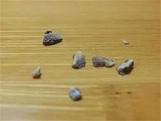 去除牙结石超简单!只要用对方法!牙石随便一碰就脱落!_牙齿_时候_效果