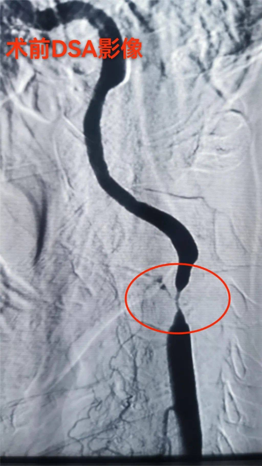 溶栓 介入取栓打通急性脑梗死患者"生命通道"_血管_支架_动脉