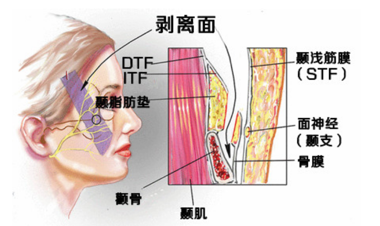 全面总结 筋膜提升和线雕哪一个好 筋膜提升和线雕有什么不一样?