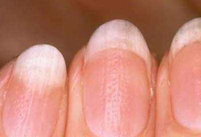 2,指甲凹凸不平,发黄中医认为肝主筋,指甲是筋的一部分