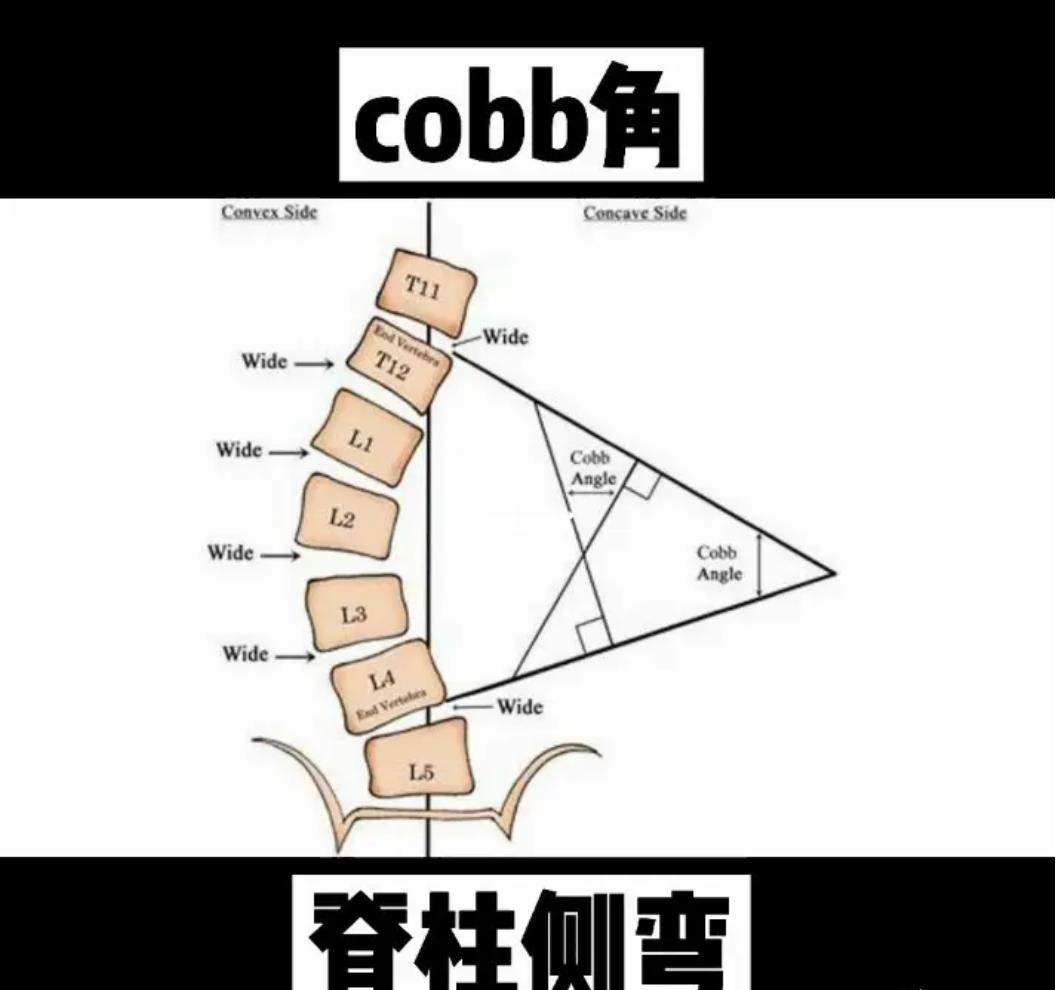 棘突偏歪图解图片