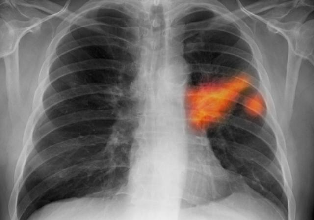 这4类人群发现有异常,及时给肺做ct